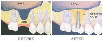 Sinus Lift Procedure Delhi India