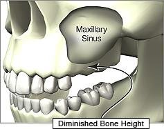 Sinus Lift Procedure Delhi India