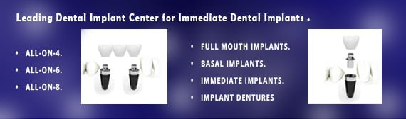 Immediate Dental Implants Delhi India