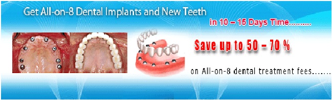 All-on-8-dental_implant