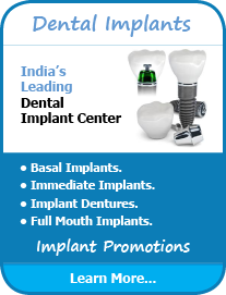 Full-mouth-Implant-treatment-india