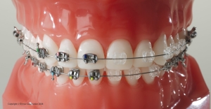 Dental braces Delhi