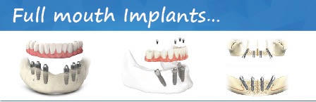 Full-mouth-Implant-treatment-india