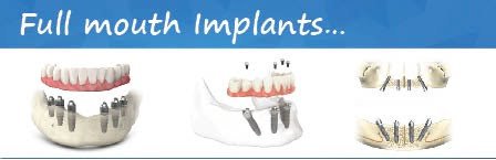 Full-mouth-Implant-treatment-india