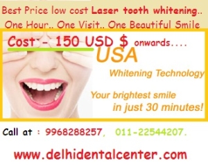 laser-tooth-whitening-Delhi-India.