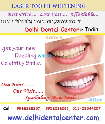 laser_teeth_whitening_procedure_Delhi_India.