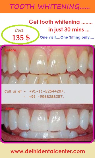 tooth-whitening-cost-delhi-india.