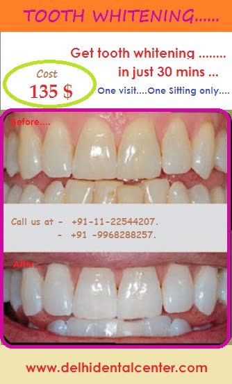 Teeth Whitening By Best Dentist In Delhi At Affordable Prices Delhi Dental Center Dental Implants Braces And Tooth Whitening In Delhi India