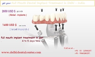 All-on-4 implants Delhi Dental Center - India.