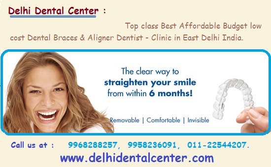 Dental Braces Dentist East Delhi