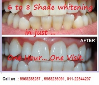 laser_teeth_whitening_clinic_in_Delhi_India.
