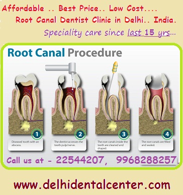 Root Canal Treatment in East Delhi India