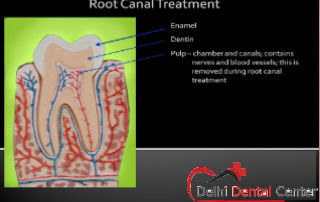 Best price Root Canal Treatment in Delhi