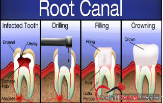 Best price Root Canal Treatment in Delhi