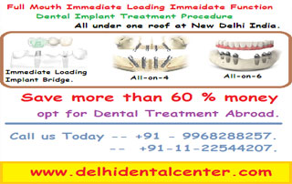 dental implant delhi