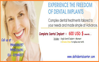 Cheap and Best Dental Implant in Delhi India