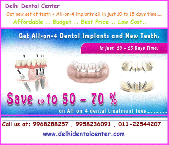 All-on-4 Dental Implant in India