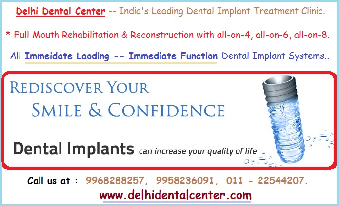 Cost of full mouth All-on-4 dental implant in India