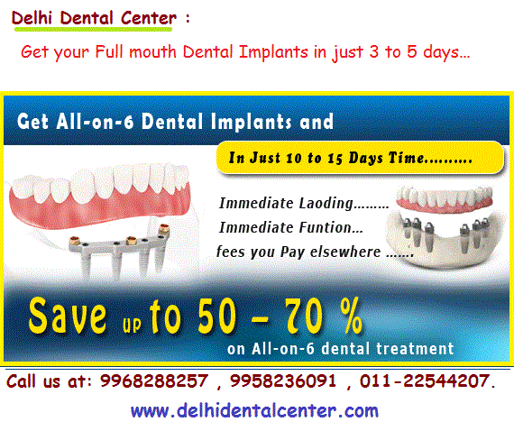 Cheap All on four implant in India