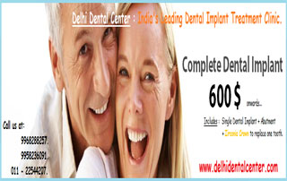 Get Best price of All on four dental implant in India