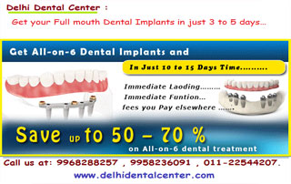 All-on-4 dental implant center in India