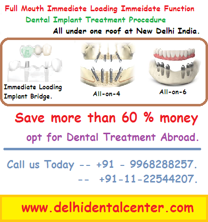 Best price Full Mouth implant procedure in India