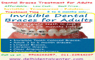 Full Mouth Dental Implant Delhi India