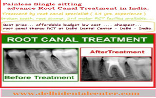 Root Canal Treatment (RCT) in East Delhi, India