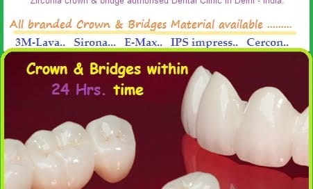3M-LAVA-crown-Dentist-Dental-Clinic-Delhi-India.