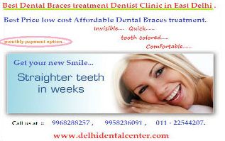 dental braces in Delhi