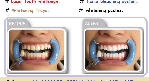 Teeth Whitening Dentist in East Delhi
