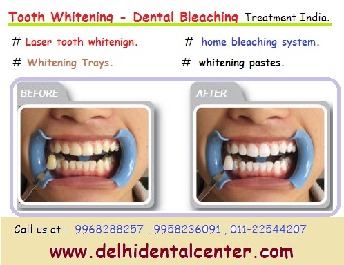 Laser Tooth Whitening Delhi