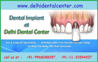 Dental Implant in Delhi India