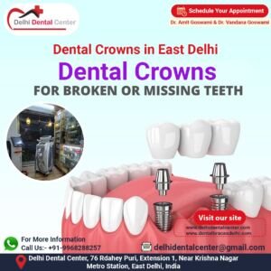 Dental Crowns in East Delhi