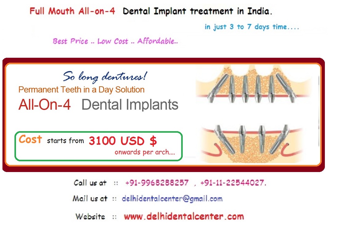 All on 4 Dental Implants in Delhi
