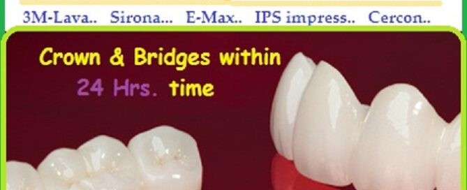 Porcelain Zirconia Ceramic CAD CAM Metal Free Dental Tooth Crowns, Dental Tooth Cap Treatment at Dental Crown Dentist Dental Clinic in Vaishali, Noida, Ghaziabad
