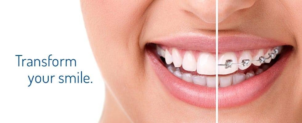 Adult Dental Braces Delhi, braces dentist Delhi, Braces Clinic Delhi