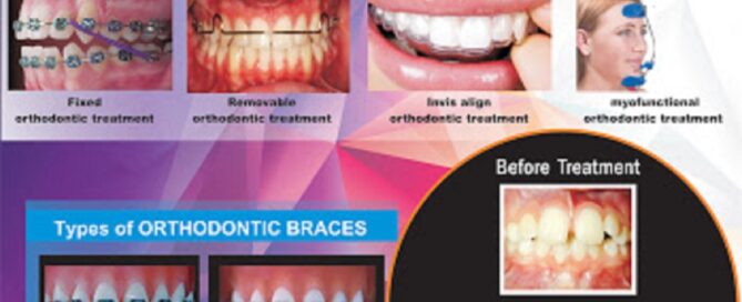 Dental Braces in East Delhi