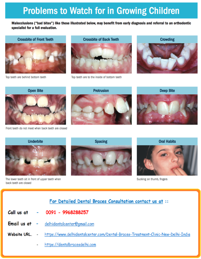 Dental Braces Treatment in Vishwas Nagar