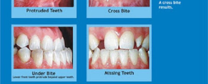 Dental Braces Treatment in East Delhi,