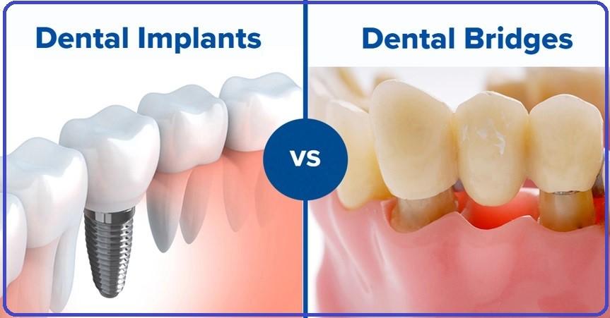 Dental Implan Vs Dental Bridges