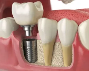 Dental-Implants