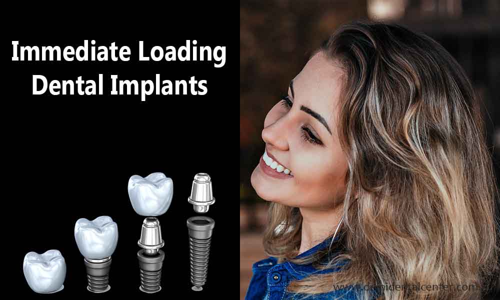 One Day Dental Implants