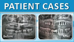 Implant Case 2 1