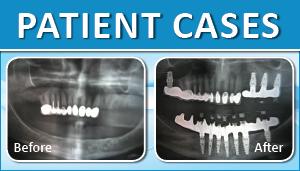 Implant Case 5