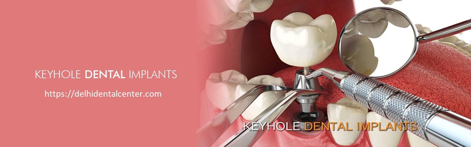 Benefits and Advantages of Dental Implants