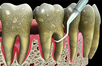 Gum Disease