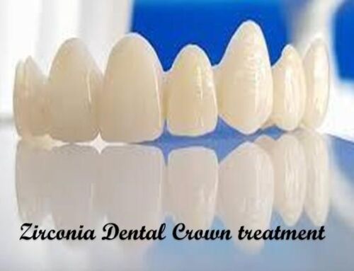 Zirconia Dental Crowns in East Delhi