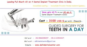 All on 4 Dental Implants in Delhi