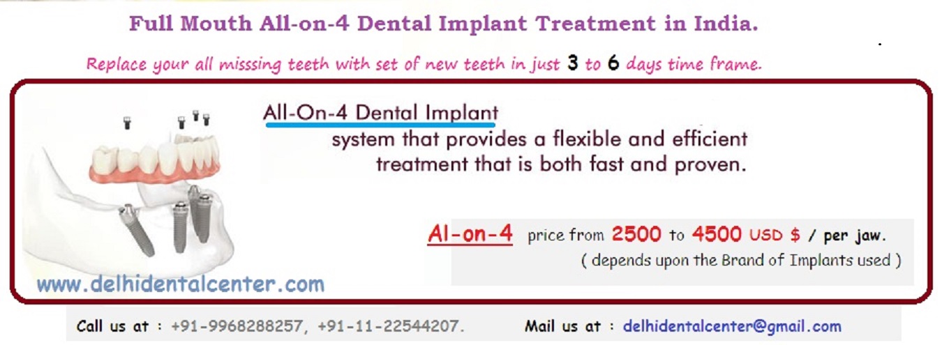 all-on-4 dental implants cost India